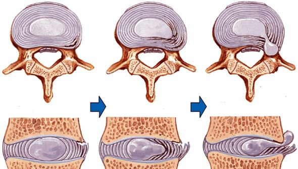 spinal injuries in osteochondrosis