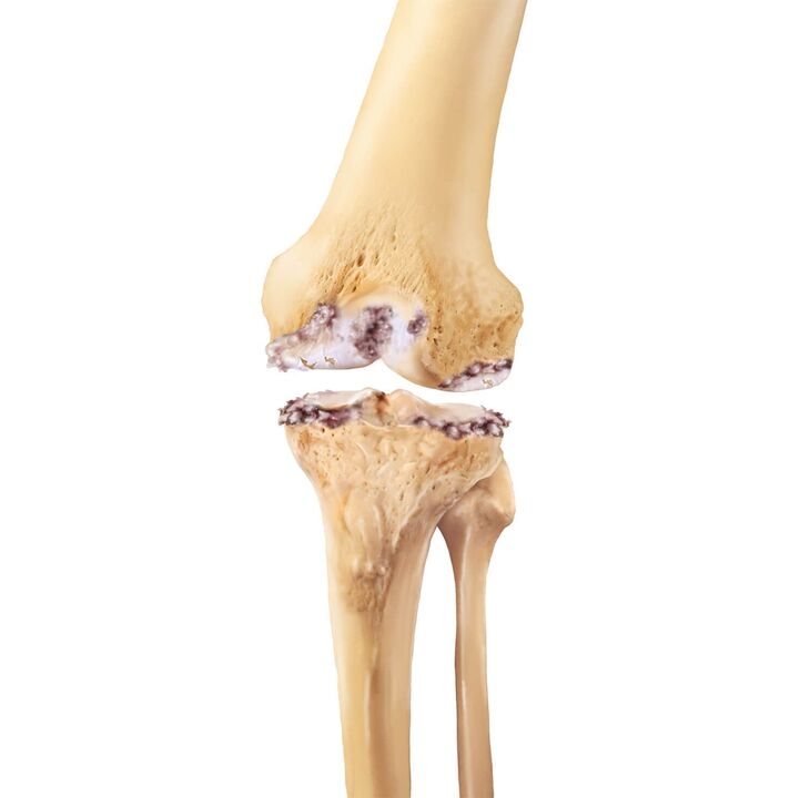 destruction of the knee joint with osteoarthritis