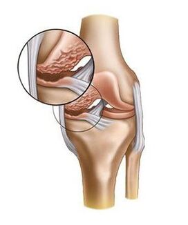 Damaged cartilage