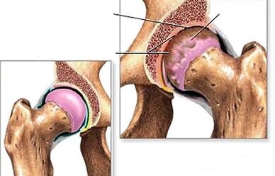 Diagnosis of the Arthrosis of the Hook