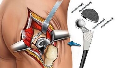 EndoProsthetics for hip arthrosis