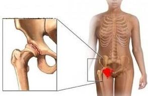 Reasons for developing the Arthrosis of the hip joint