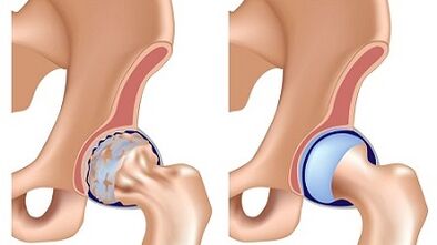 Symptoms of Arthrosis Hook's wrist