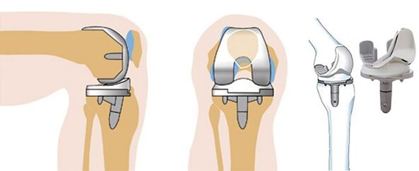 EndoProsthetics Work of connecting knees for arthrosis