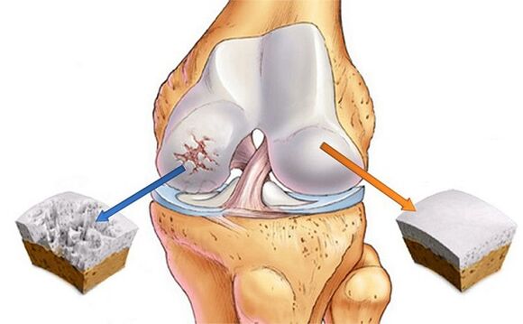 Norm and deviation for knee joint arthritis