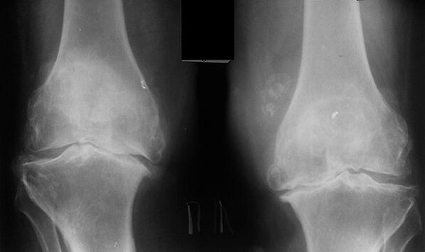 X -Ray as a way of diagnosing the arthrosis of the knee wrist