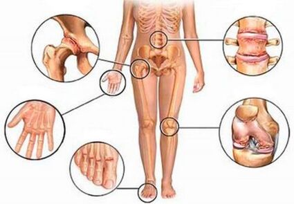 Arthritis and arthrosis of different joints
