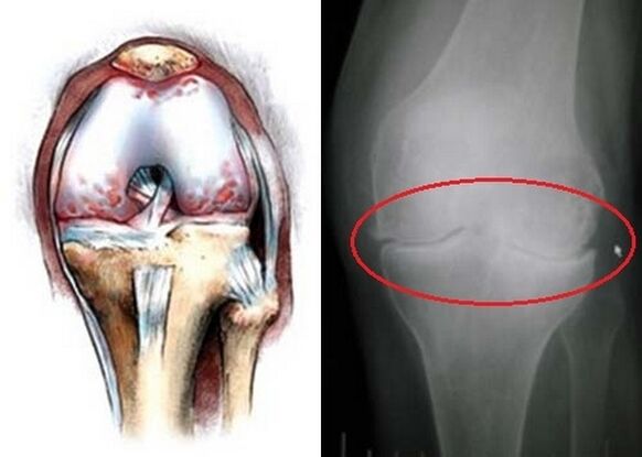 Deformation of a shared knee for arthrosis