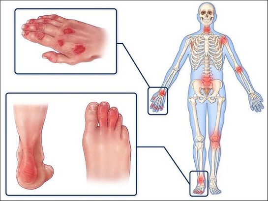Redness of the skin and swelling of the wrists with arthritis
