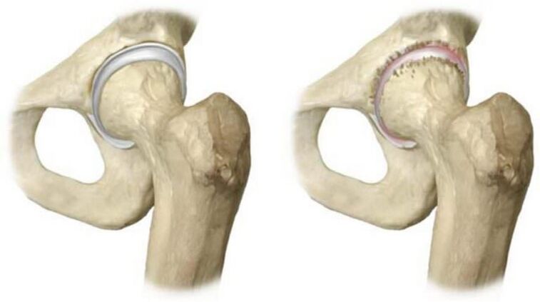 healthy hip joint and head necrosis as the cause of pain