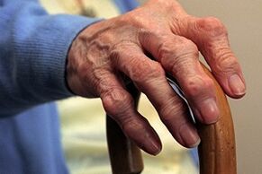finger damage by osteoarthritis