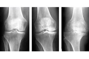 phases of arthrosis of the joint on X-ray