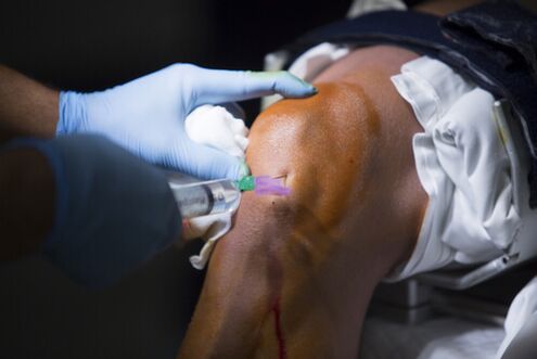 Injections into the knee joint due to arthrosis
